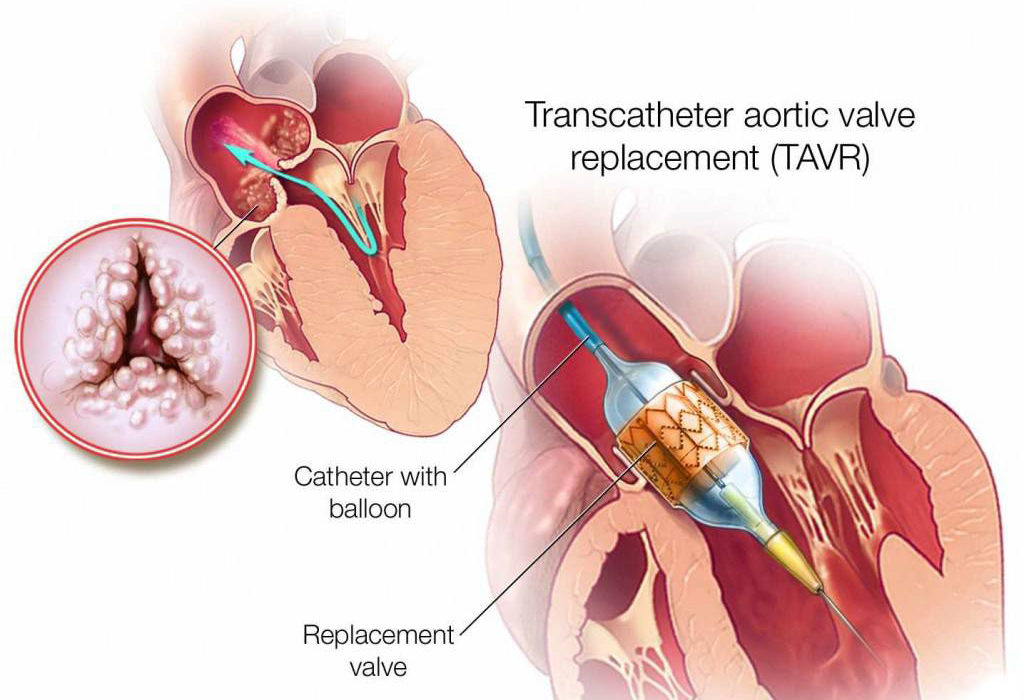 TAVR